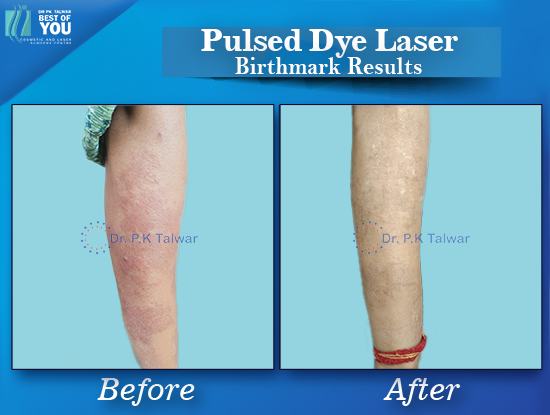 Pulsed Dye Laser Result